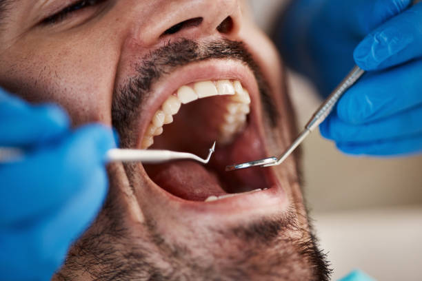 Best Emergency Dentist for Lost Fillings or Crowns in Comanche, TX